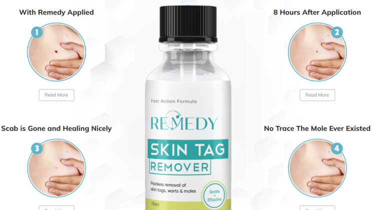 Remedy Skin Tag Remover- Up to 30% OFF on your first order!